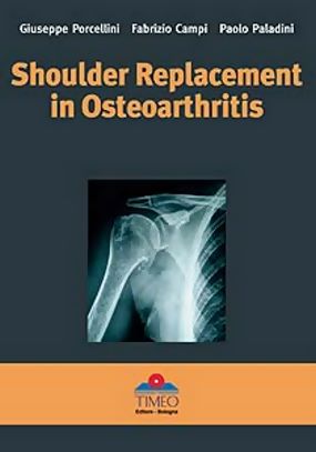 Shoulder Replacement in Osteoarthritis (trovasi anche la versione italiana)